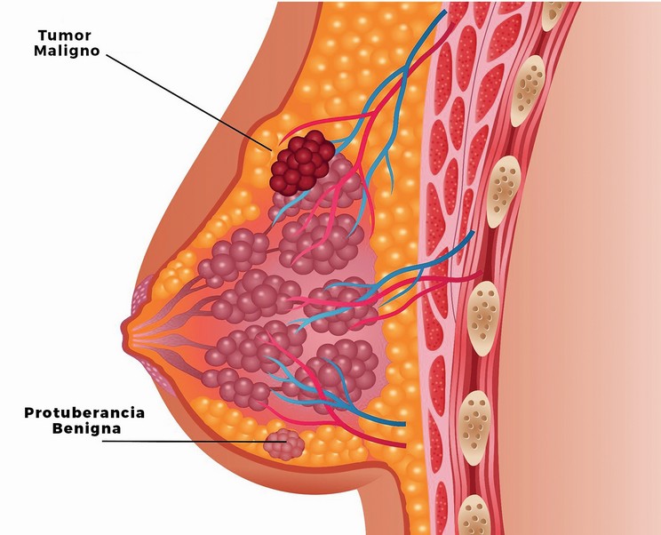 En este momento estás viendo Lo que debo saber sobre Cáncer de Mama.